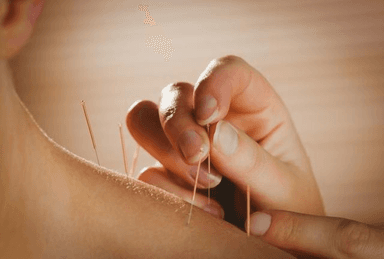 Image for Acupuncture (subsequent)