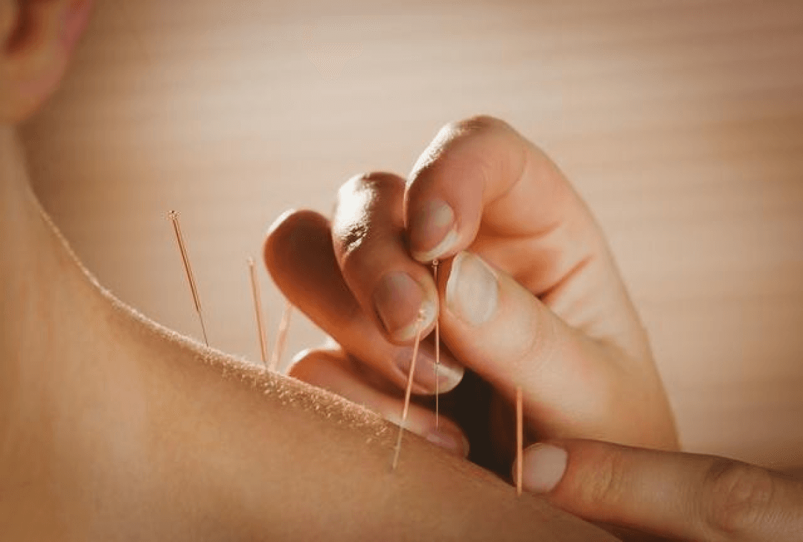 Image for Acupuncture (Covered by Insurer Plan)